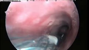 Коллапс трахеи у собаки постановка стента.