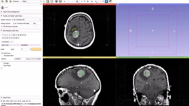 How to Tutorial Video: GBM Volumetry using the 3D Slicer Medical Image Computing Platform смотреть онлайн