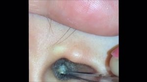 Удаление ушной пробки #69