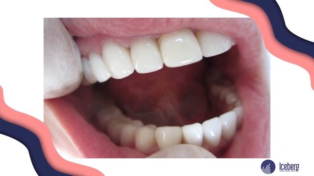 ВАМ НУЖНО ЭТО ЗНАТЬ ПЕРЕД УСТАНОВКОЙ ЗУБНЫХ КОРОНОК / Типы коронок, материалы, стоимость смотреть онлайн