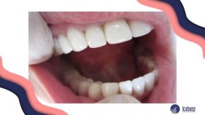 ВАМ НУЖНО ЭТО ЗНАТЬ ПЕРЕД УСТАНОВКОЙ ЗУБНЫХ КОРОНОК / Типы коронок, материалы, стоимость