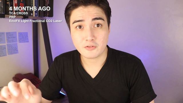 HOW TO GET RID OF YOUR ACNE SCARS (By Mr. Psalm Galope) 2021 смотреть онлайн