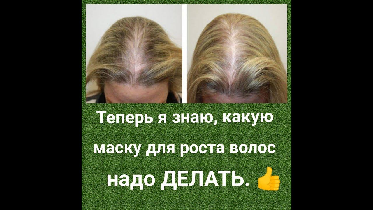 Супер маска для РОСТА ВОЛОС и против ВЫПАДЕНИЯ. смотреть онлайн