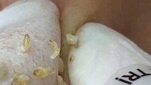 Extrusion of black dots.  ВЫДАВЛИВАНИЕ ЧЕРНЫХ ТОЧЕК  #черныеточки #косметология #чистота #жайдарман