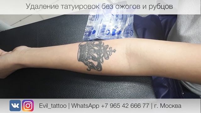Лазерное удаление татуировки в студии Evil Tattoo. Без травм, ожогов и рубцов. смотреть онлайн