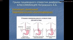 Диафрагмальные грыжи. Госпитальная хирургия. Джуракулов Ш.Р. 5 курс