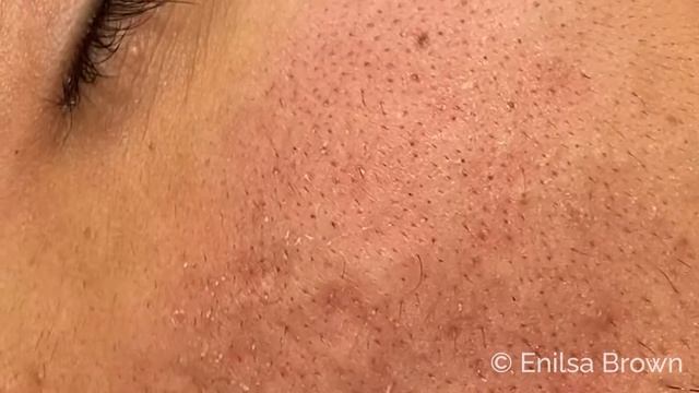 Blackhead & Whitehead Extractions on "K" Part 4 смотреть онлайн