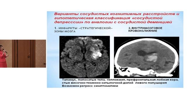 Некоторые особенности ведения больных, перенесших инсульт смотреть онлайн