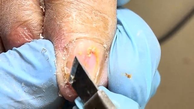 Onychomycosis deteriorates in the middle! Professional pedicure【Xue Yidao】 смотреть онлайн