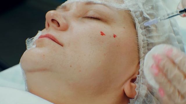 FEMEGYL R ИМПЛАНТАТ ВНУТРИДЕРМАЛЬНЫЙ БИОЛИФТ смотреть онлайн