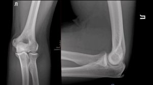 Укладка локтевого сустава