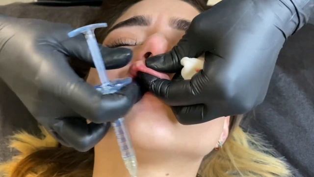 Контурная пластика губ. смотреть онлайн