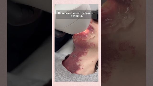 Гемангиома на лице. IPL лечение.Повторный сеанс