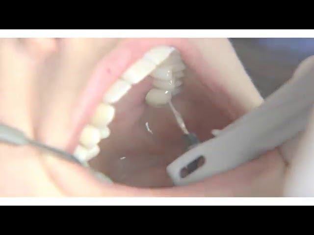 Vector PARO. Парадонтологический аппарат Обзор смотреть онлайн