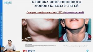 Инфекционный мононуклеоз у детей