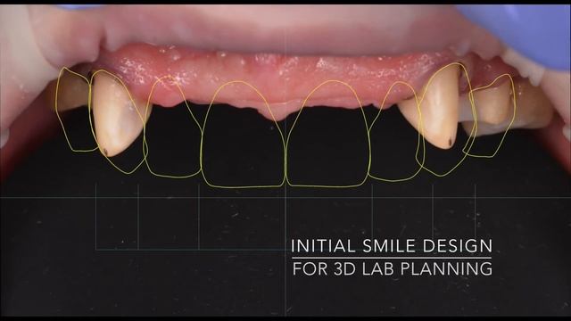 Intraoral scanner PEEK / PEKTON Vitablocs Veneers (Carestream Dental CS3600) Full-Arch Capture смотреть онлайн