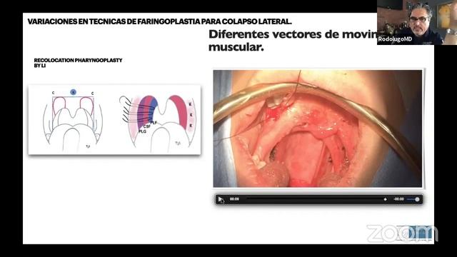 Abordaje ORL del SAHOS смотреть онлайн
