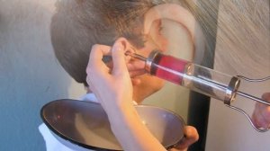 ПРОБКА В УХЕ ЧТО ДЕЛАТЬ | Как понять что у вас пробка в ухе