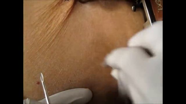 How To Give Goserelin Injection By Subcutaneous Mode? смотреть онлайн