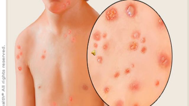 Lecture of Dr. Iram Quershi on Topic AIR BORNE INFECTIONS смотреть онлайн