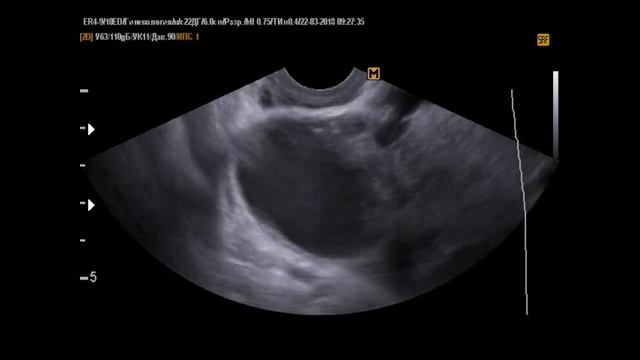 Кисты, кисты, гидросальпинкс (22-3-18)