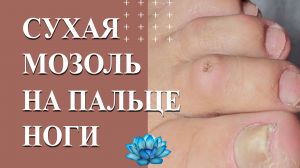 Мозоль на пальце ноги. Что делать?