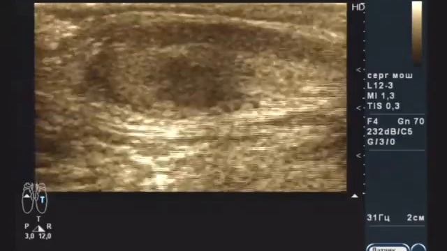 Лимфома Беркитта, поражение яичек