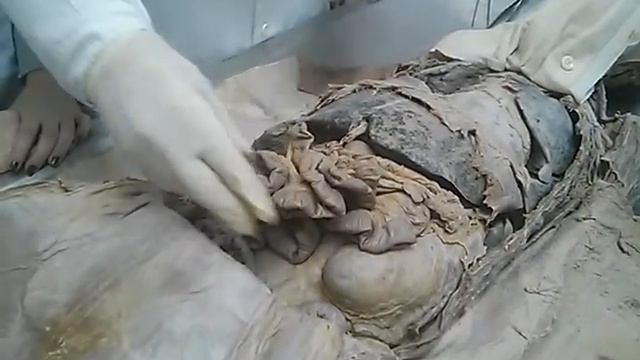 Брюшина. Peritoneum. анатомия часть 3 смотреть онлайн