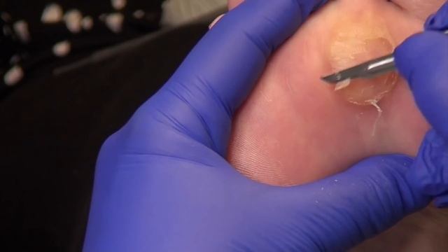 What makes this Callus SOOO Big ?? смотреть онлайн