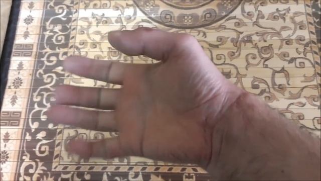 Порез сухожилия сгибателя пальца. | © 2014 смотреть онлайн