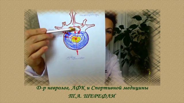 Может ли грыжа позвоночника "рассосаться"? смотреть онлайн
