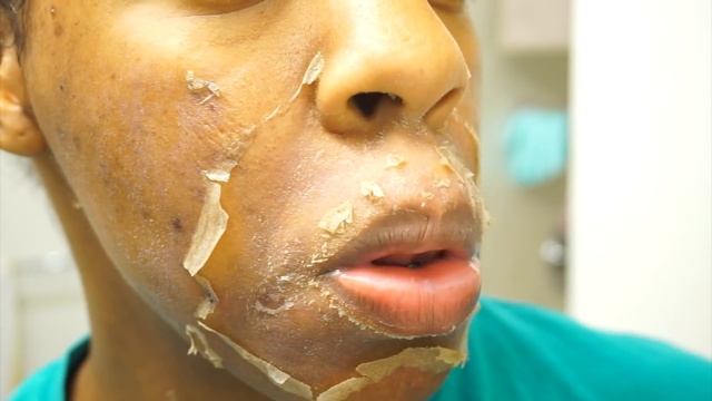 I GOT A CHEMICAL PEEL ! Full Process + Results | Remove Dark Marks, Enlarged Pores & Wrinkles смотреть онлайн