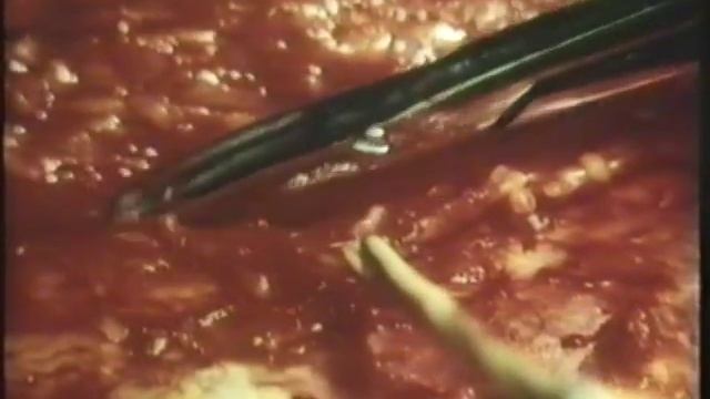 Хирургия верхнегрудного отдела позвоночника © Surgery complicated spinal injury смотреть онлайн