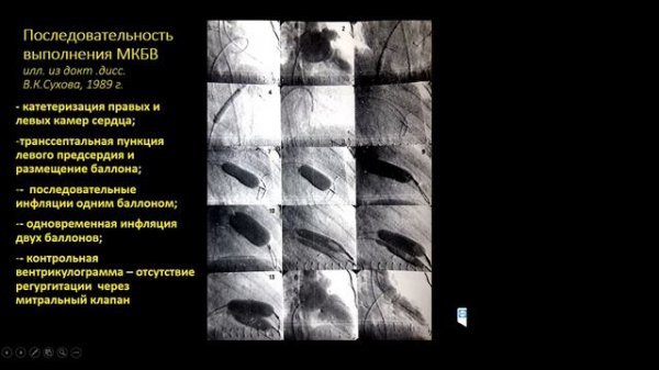 Лекция №13. Пороки створчатых клапанов сердца: проблемы диагностики и лечения