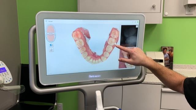 iTero 5D Digital Intra-Oral Scanner смотреть онлайн