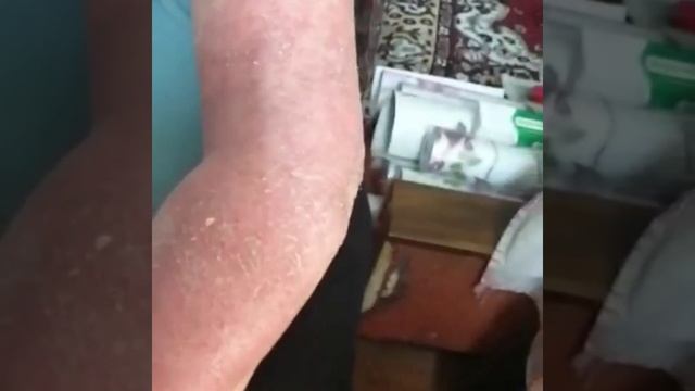 Рожистое воспаление руки. смотреть онлайн