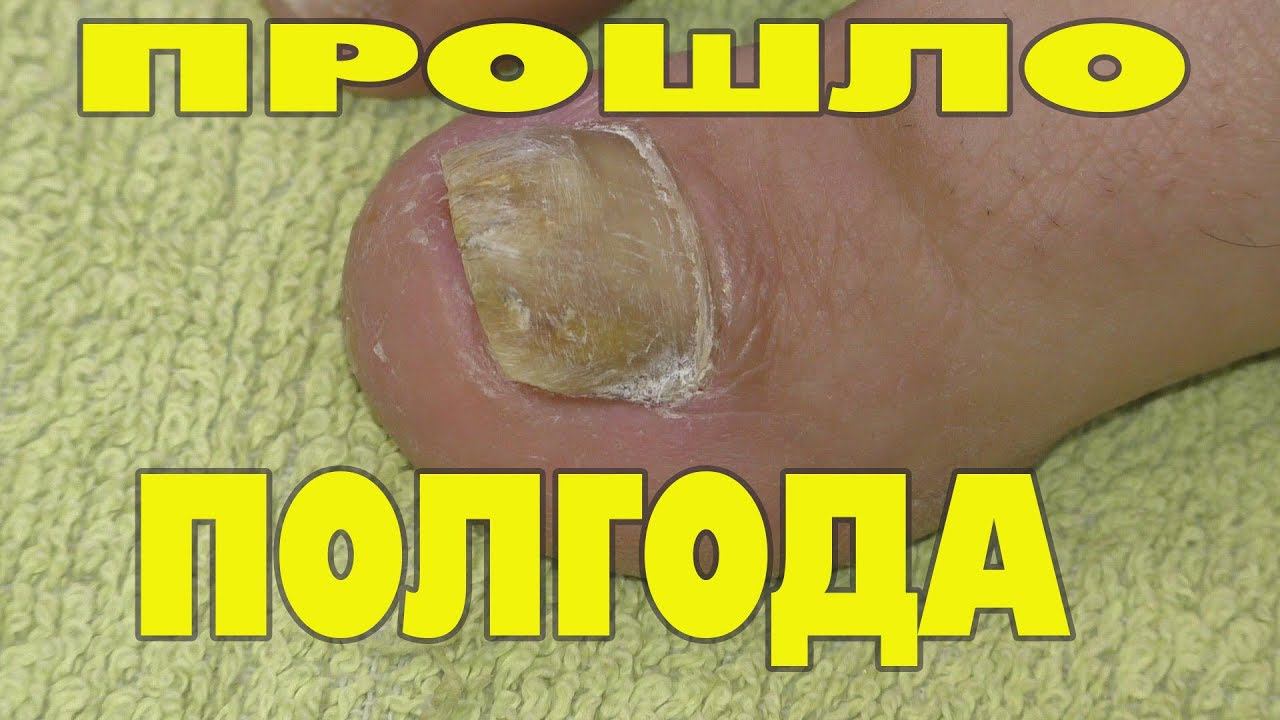 Грибок ногтя на ноге Отзывы для вас смотреть онлайн