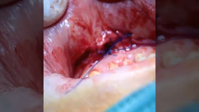 Immediate implant placement with simultaneous bone plasty in anterior maxilla смотреть онлайн