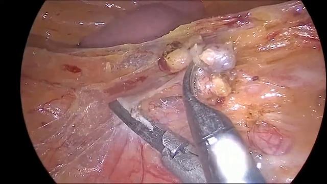 Radical apical lymph node dissection guided by carbon nanoparticles in laparoscopic rectal surgery смотреть онлайн
