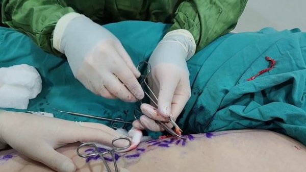 miniflebektomiya usulu nedir nece edilir fleboloq cerrah ismayil esgerov varikoz damar emeliyyati