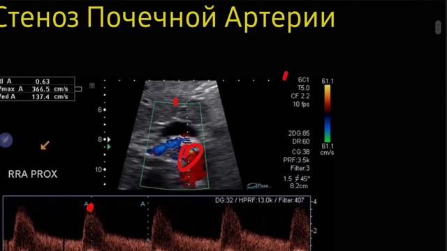 Стеноз Почечной Артерии смотреть онлайн