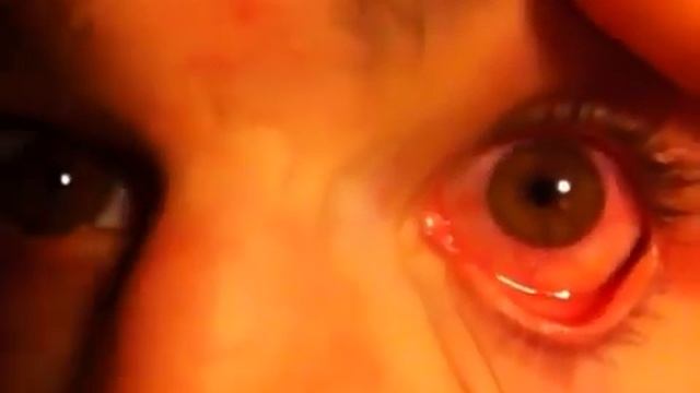 КОНЬЮКТИВИТ смотреть онлайн