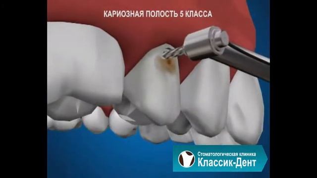 Классик-Дент: Кариозная полость 5й класс смотреть онлайн