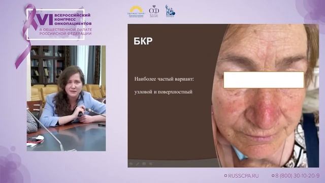 Назарова Валерия Витальевна - Диагностика меланомы и опухолей кожи смотреть онлайн