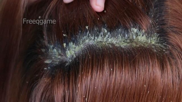 Removal Dandruff Flakes With Lice Comb | Psoriasis Flakes Scalp #603 смотреть онлайн
