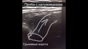 Прямая паховая грыжа при УЗИ. Профессор Гажонова В.Е.