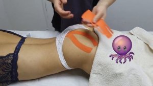 Тейпирование ягодичной мышцы. Лимфодренажное кинезиотейпирование ягодиц.