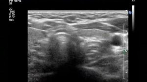 Лимфогранулематоз, ремиссия, надключичная лимфаденопатия