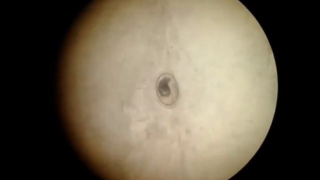 Описторхоз