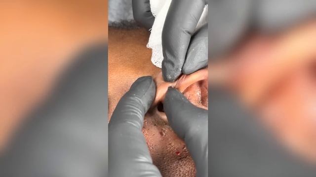 Popping huge blackheads and Giant Pimples - Best Pimple Popping Videos #76 смотреть онлайн